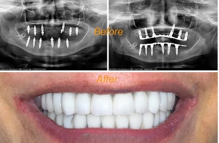 Chirurgie esthétique gingivale