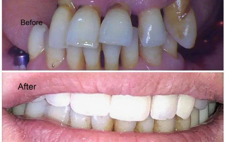 Traitement parodontite avancée